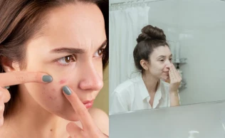 Aprender sobre acne é fundamental para compreender essa condição dermatológica comum.