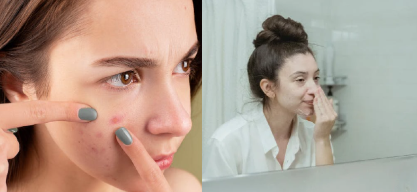 Aprender sobre acne é fundamental para compreender essa condição dermatológica comum.